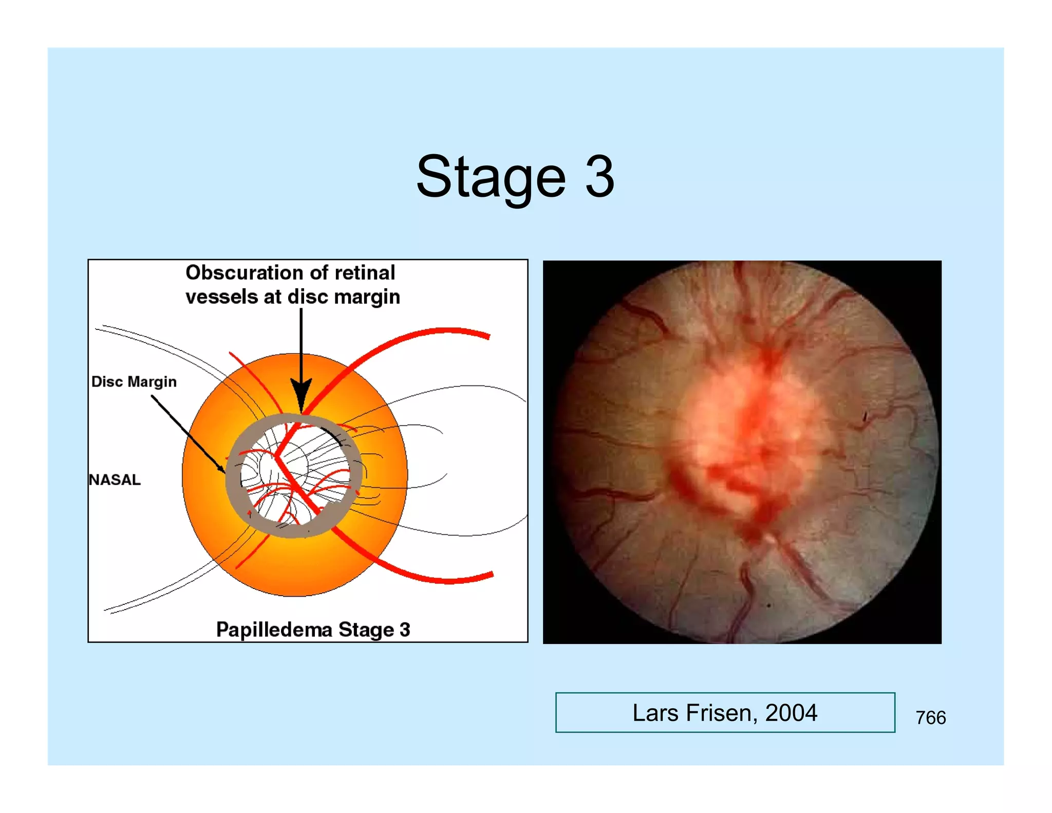Stage 3

Lars Frisen, 2004

766

 