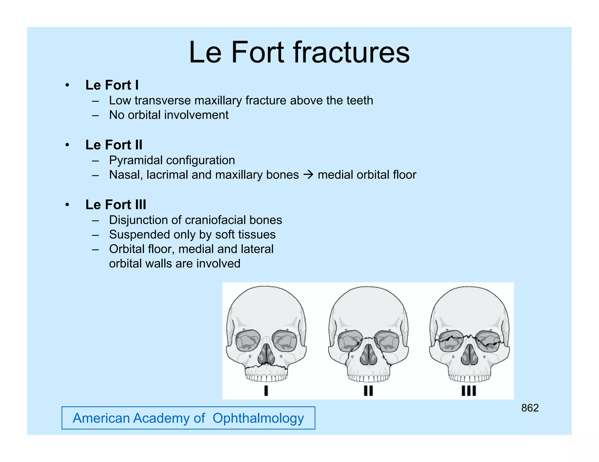 Le Fort fractures
•

Le Fort I
– Low transverse maxillary fracture above the teeth
– No orbital involvement

•

Le Fort II
– Pyramidal configuration
– Nasal, lacrimal and maxillary bones  medial orbital floor

•

Le F t
L Fort III
– Disjunction of craniofacial bones
– Suspended only by soft tissues
– Orbital floor, medial and lateral
orbital walls are i
bit l
ll
involved
l d

American Academy of Ophthalmology

862

 