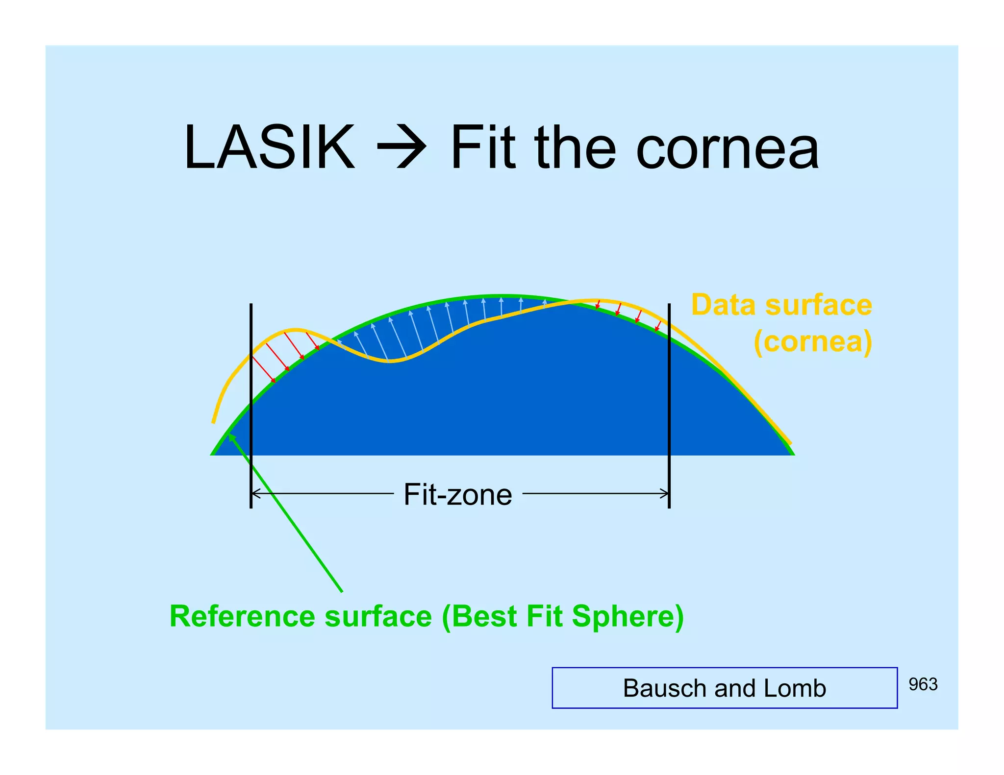 LASIK  Fit the cornea
Data surface
(cornea)

Fit-zone

Reference surface (Best Fit Sphere)
(
p
)
Bausch and Lomb

963

 