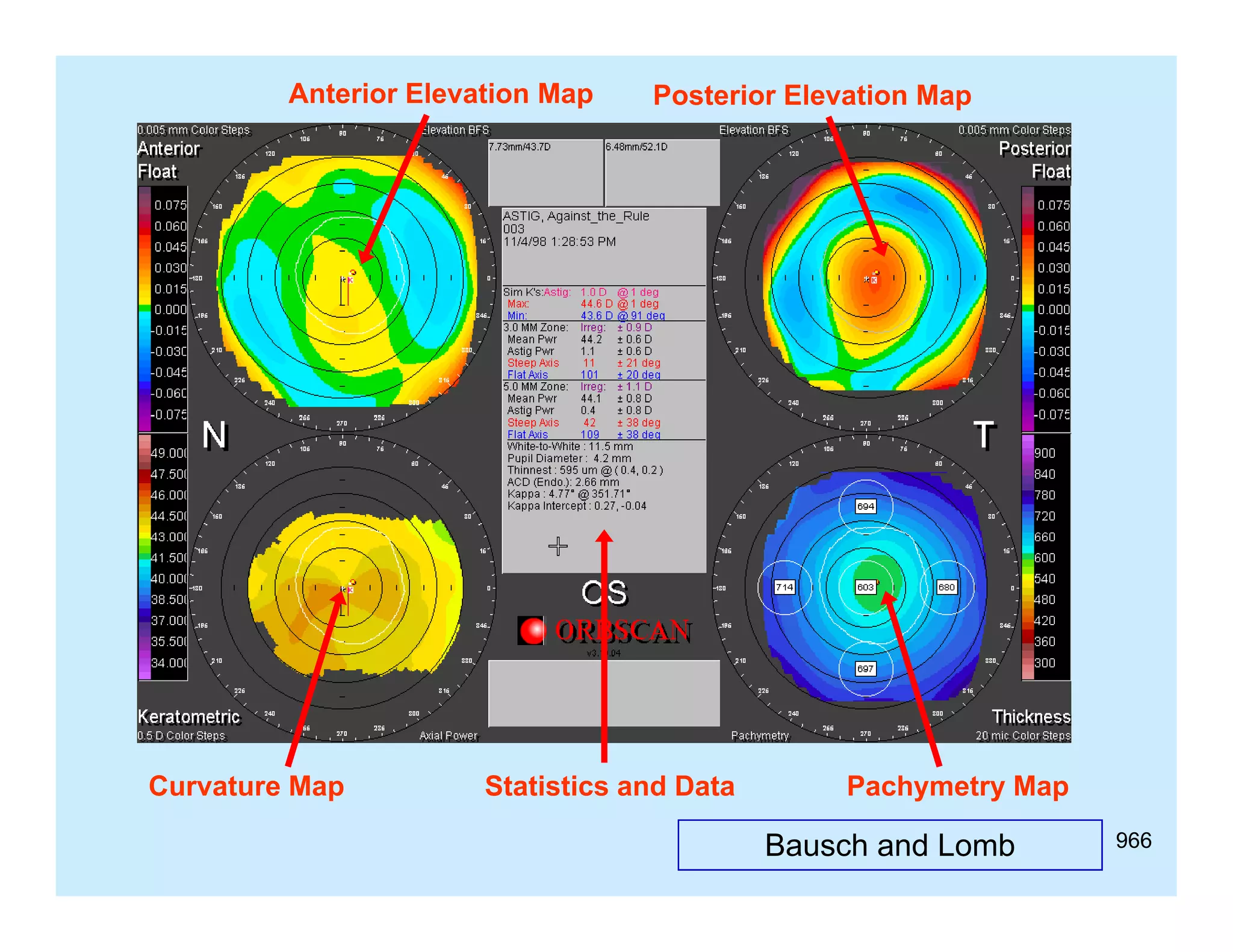 Anterior Elevation Map

Curvature M
C
Map

Posterior Elevation Map

Statistics d D
S i i and Data

Pachymetry Map
P h
M

Bausch and Lomb

966

 