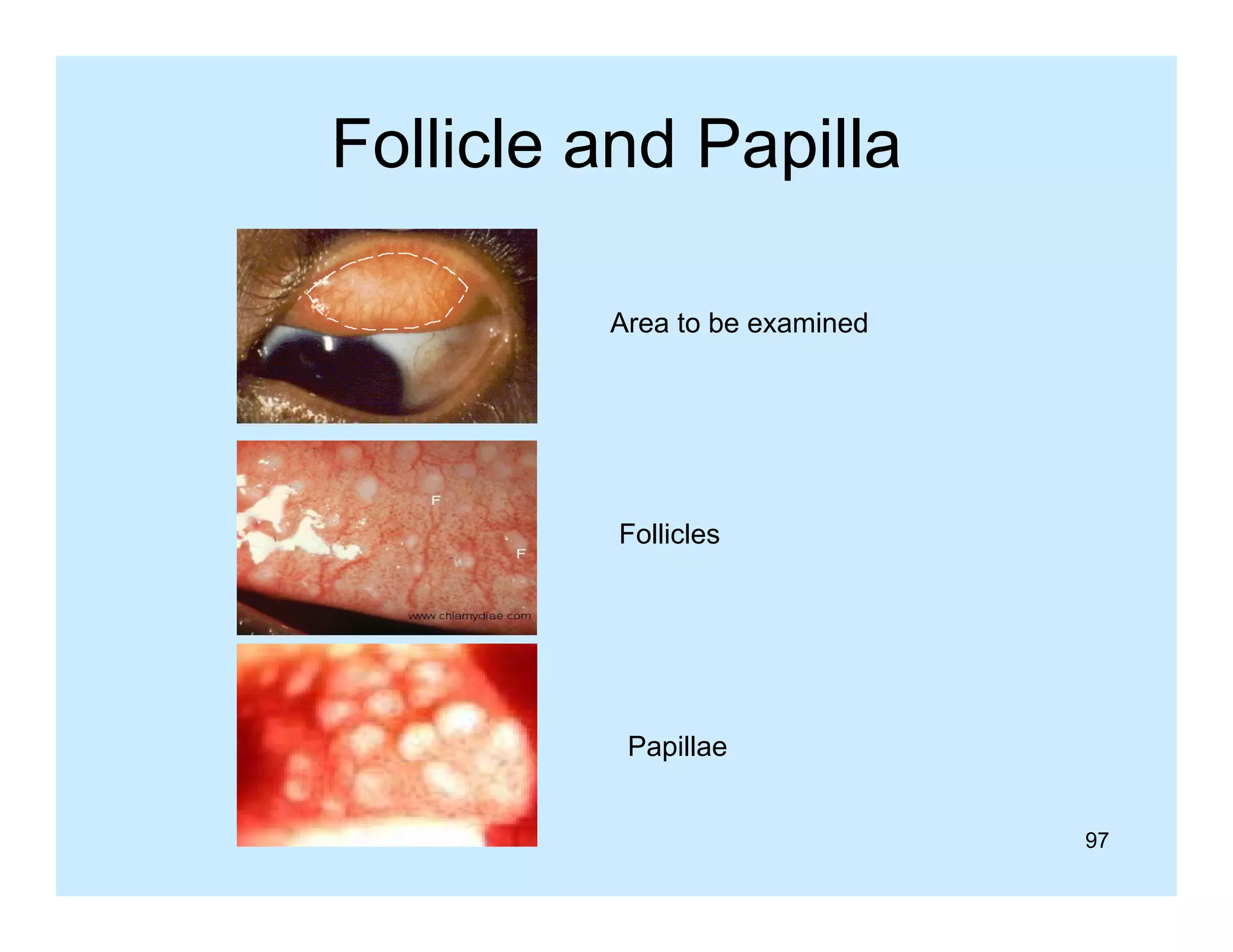 Follicle and Papilla
p
Area to be examined

Follicles

Papillae
97

 