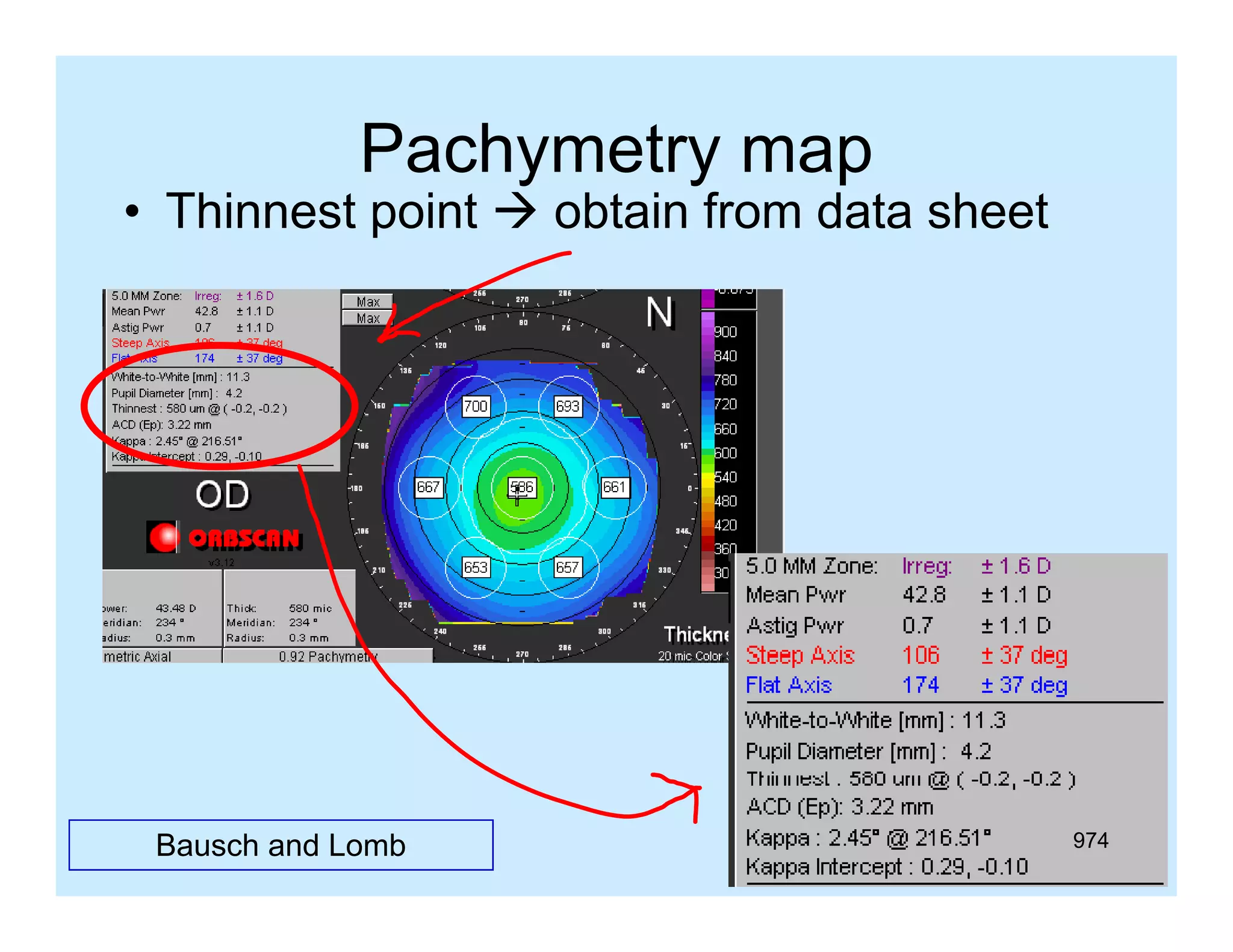 Pachymetry map
y
y
p

• Thinnest point  obtain from data sheet

Bausch and Lomb

974

 