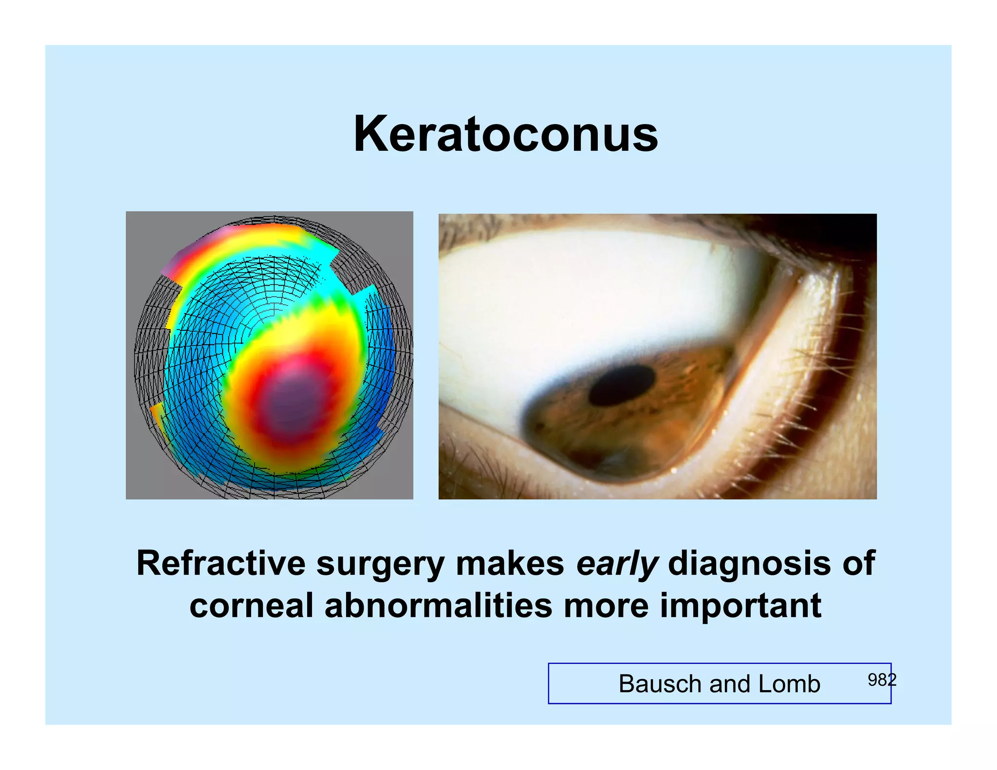 Keratoconus

Refractive surgery makes early diagnosis of
corneal abnormalities more important
Bausch and Lomb

982

 