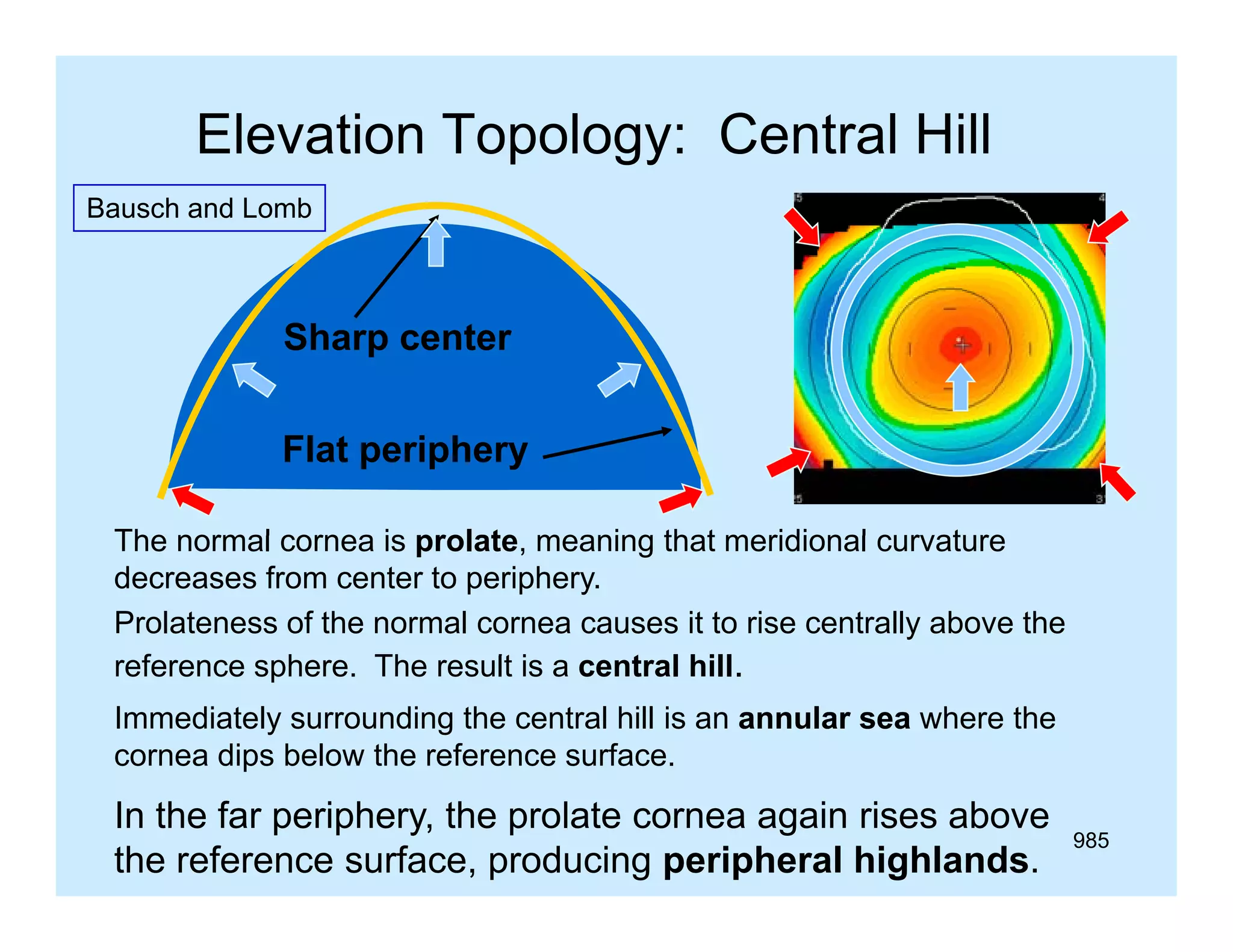 Elevation Topology: Central Hill
Bausch and Lomb

Sharp center
Flat periphery
The normal cornea is prolate meaning that meridional curvature
prolate,
decreases from center to periphery.
Prolateness of the normal cornea causes it to rise centrally above the
reference sphere. The result is a central hill.
f
h
Th
lt i
t l
Immediately surrounding the central hill is an annular sea where the
cornea dips below the reference surface.

In the far periphery, the prolate cornea again rises above
the reference surface, producing peripheral highlands.

985

 