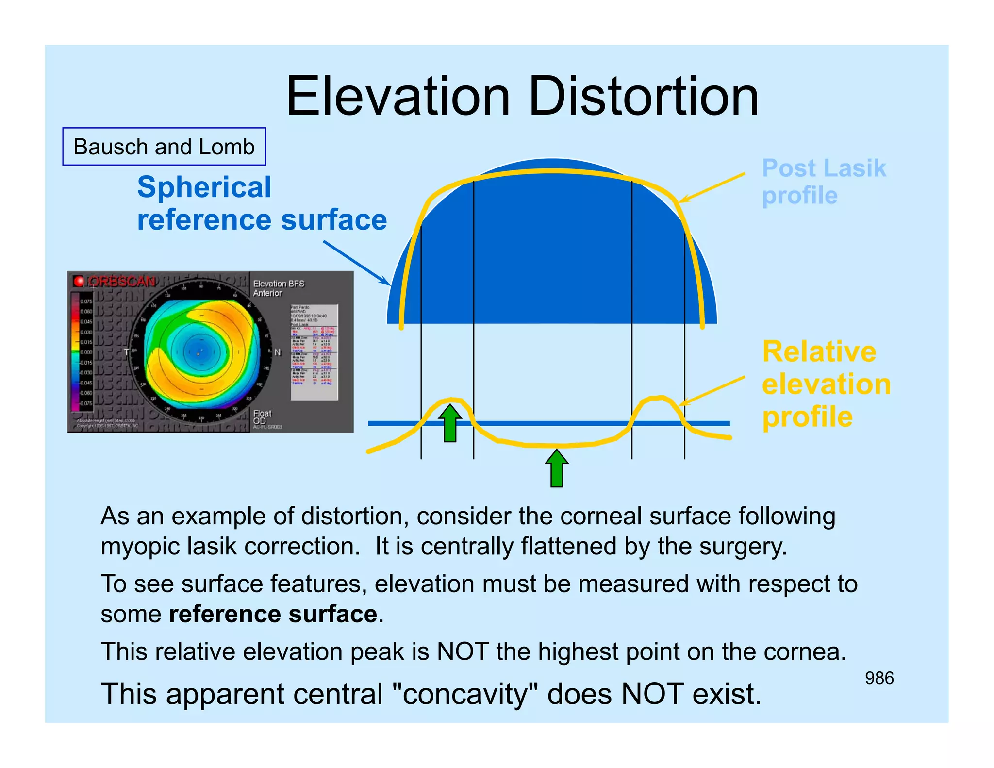 Elevation Distortion
Bausch and L b
B
h d Lomb

Spherical
reference surface

Post Lasik
profile

Relative
elevation
p
profile
As an example of distortion, consider the corneal surface following
p
g
myopic lasik correction. It is centrally flattened by the surgery.
To see surface features, elevation must be measured with respect to
some reference surface.
This relative elevation peak is NOT the highest point on the cornea.

This apparent central "concavity" does NOT exist.

986

 