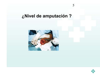 5


¿Nivel de amputación ?
 