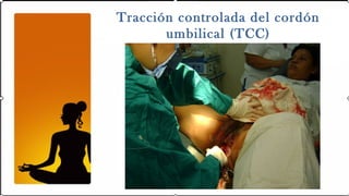 Tracción controlada del cordón
       umbilical (TCC)
 