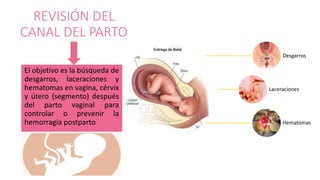 REVISIÓN DEL
CANAL DEL PARTO
El objetivo es la búsqueda de
desgarros, laceraciones y
hematomas en vagina, cérvix
y útero (segmento) después
del parto vaginal para
controlar o prevenir la
hemorragia postparto
Desgarros
Laceraciones
Hematomas
 