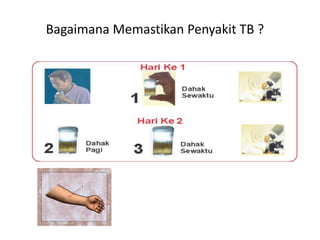 Bagaimana Memastikan Penyakit TB ?
 