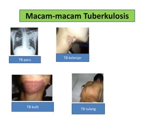 Macam-macam Tuberkulosis
TB paru
TB kelenjar
TB kulit
TB tulang
 