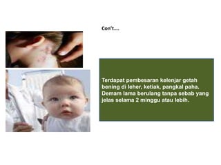 Con’t….
Terdapat pembesaran kelenjar getah
bening di leher, ketiak, pangkal paha.
Demam lama berulang tanpa sebab yang
jelas selama 2 minggu atau lebih.
 