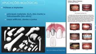 APLICAÇÕES BIOLÓGICAS
 Próteses e implantes
 principais materiais: Al2O3 (bio-inerte) e
hidroxiapatita (bio-ativa)
 ossos artificiais, dentes e juntas
http://www.rydesky.com/Veneers.html
 