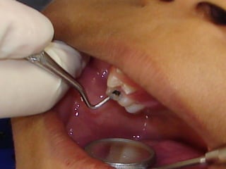 6. Condicionamento da superfície
       dentária com ácido fraco
1. Remoção de dentina cariada com curetas
2. Limpeza dos ...