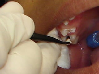 8. Secagem com bolinha de
         algodão
1. Remoção de dentina cariada com curetas
2. Limpeza dos sulcos adjacentes
3. A...