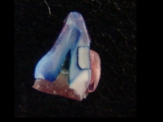 Materiais dentários em odontopediatria
