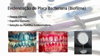 Evidenciação de Placa Bacteriana (Biofilme)
• Exame Clínico;
• Espelho Comum;
• Solução ou Pastilha Evidenciadora.
 