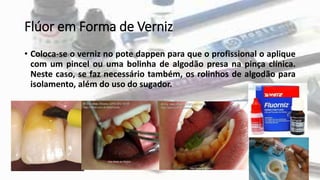 Flúor em Forma de Verniz
• Coloca-se o verniz no pote dappen para que o profissional o aplique
com um pincel ou uma bolinha de algodão presa na pinça clínica.
Neste caso, se faz necessário também, os rolinhos de algodão para
isolamento, além do uso do sugador.
 
