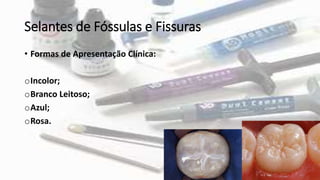Selantes de Fóssulas e Fissuras
• Formas de Apresentação Clínica:
oIncolor;
oBranco Leitoso;
oAzul;
oRosa.
 