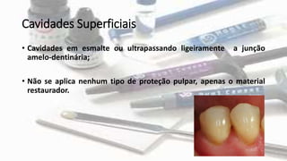 Cavidades Superficiais
• Cavidades em esmalte ou ultrapassando ligeiramente a junção
amelo-dentinária;
• Não se aplica nenhum tipo de proteção pulpar, apenas o material
restaurador.
 