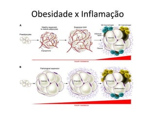 Obesidade x Inflamação
 