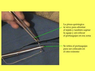 La pinza quirúrgica 
te sirve para afrontar 
el tejido y también sujetar 
la aguja y así colocar 
el portaagujas en esa zo...