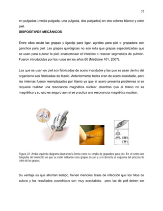 32

en pulgadas (media pulgada, una pulgada, dos pulgadas) en dos colores blanco y color
piel.
DISPOSITIVOS MECÁNICOS


Entre ellos están las grapas y ligaclip para ligar, agrafes para piel o grapadora con
ganchos para piel. Las grapas quirúrgicas no son más que grapas especializadas que
se usan para suturar la piel, anastomosar el intestino o resecar segmentos de pulmón.
Fueron introducidas por los rusos en los años 60 (Medicine 101, 2007).


Las que se usan en piel son fabricadas de acero inoxidable y las que se usan dentro del
organismo son fabricadas de titanio. Anteriormente todas eran de acero inoxidable, pero
las internas fueron reemplazadas por titanio ya que el acero presenta problemas si se
requiere realizar una resonancia magnética nuclear, mientras que el titanio no es
magnético y su uso es seguro aun si se practica una resonancia magnética nuclear.




Figura 22. Arriba izquierda diagrama ilustrando la forma como se emplea la grapadora para piel. En el centro una
fotografía del momento en que se están retirando esas grapas de piel y a la derecha el esquema del proceso de
retiro de las grapas.



Su ventaja es que ahorran tiempo, tienen menores tasas de infección que los hilos de
sutura y los resultados cosméticos son muy aceptables, pero las de piel deben ser
 