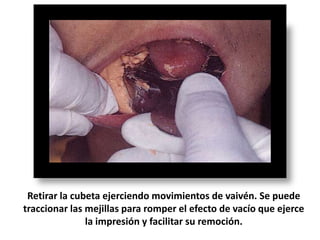 Retirar la cubeta ejerciendo movimientos de vaivén. Se puede
traccionar las mejillas para romper el efecto de vacío que ejerce
la impresión y facilitar su remoción.

 