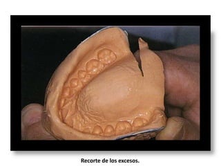 Recorte de los excesos.

 