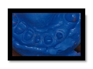 Materiales de impresion dental