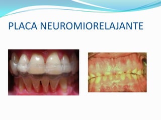 PLACA NEUROMIORELAJANTE