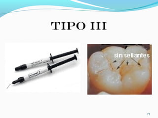 TIPO III
71
 