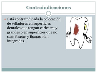 Contraindicaciones
 Está contraindicada la colocación
de selladores en superficies
dentales que tengan caries muy
grandes o en superficies que no
sean fosetas y fisuras bien
integradas.
 