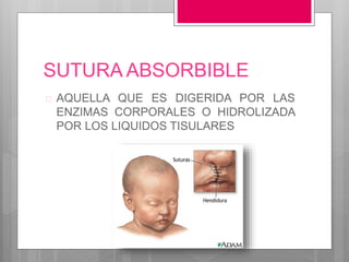 SUTURA ABSORBIBLE
 AQUELLA QUE ES DIGERIDA POR LAS
ENZIMAS CORPORALES O HIDROLIZADA
POR LOS LIQUIDOS TISULARES
 