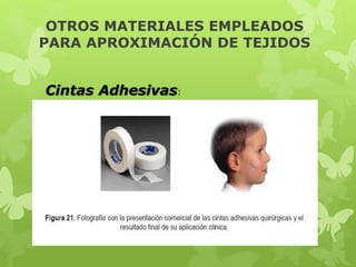 OTROS MATERIALES EMPLEADOS
PARA APROXIMACIÓN DE TEJIDOS
Cintas Adhesivas:
 