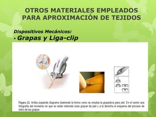 OTROS MATERIALES EMPLEADOS
PARA APROXIMACIÓN DE TEJIDOS
Dispositivos Mecánicos:
 Grapas y Liga-clip
 
