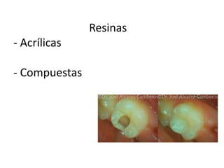 Resinas
- Acrílicas
- Compuestas
 