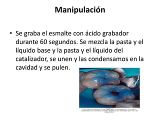 Manipulación
• Se graba el esmalte con ácido grabador
durante 60 segundos. Se mezcla la pasta y el
líquido base y la pasta y el líquido del
catalizador, se unen y las condensamos en la
cavidad y se pulen.
 