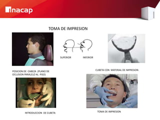 TOMA DE IMPRESION
POSICION DE CABEZA (PLANO DE
OCLUSION PARALELO AL PISO)
CUBETA CON MATERIAL DE IMPRESION
INTRODUCCION DE CUBETA TOMA DE IMPRESION
SUPERIOR INFERIOR
 