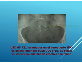 USD 65.221 incautados en el aeropuerto JFK-
46 pelets ingeridos (USD 700 c/u), 35 pelets
en el cuerpo, además de efectivo a la mano
 