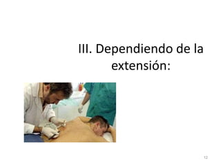 III. Dependiendo de la
extensión:
12
 