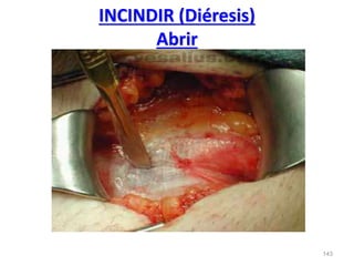 143
INCINDIR (Diéresis)
Abrir
 