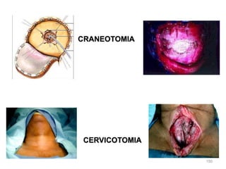 150
CRANEOTOMIA
CERVICOTOMIA
 