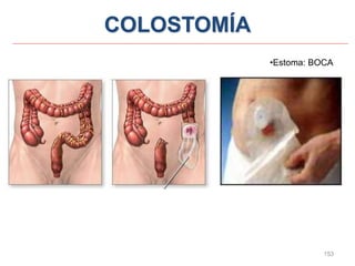 153
COLOSTOMÍA
•Estoma: BOCA
 