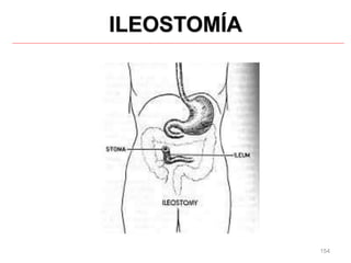 154
ILEOSTOMÍA
 