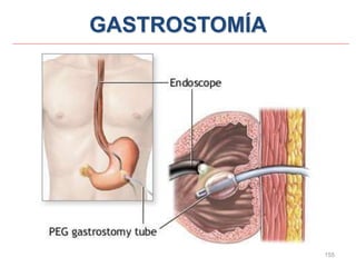 155
GASTROSTOMÍA
 