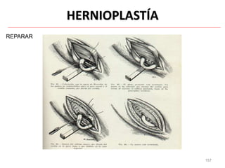 157
HERNIOPLASTÍA
REPARAR
 