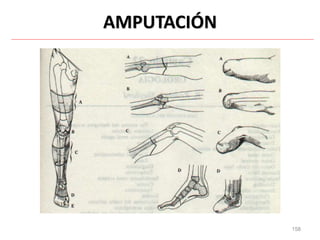 158
AMPUTACIÓN
 