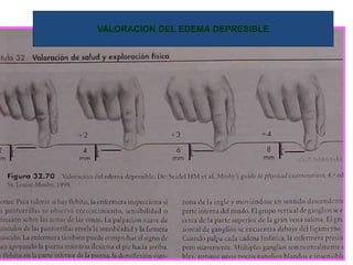 VALORACION DEL EDEMA DEPRESIBLE
 