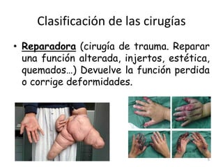 Clasificación de las cirugías
• Reparadora (cirugía de trauma. Reparar
una función alterada, injertos, estética,
quemados…) Devuelve la función perdida
o corrige deformidades.
5
 