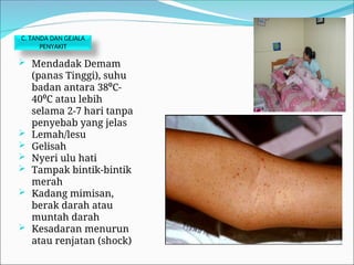 C. TANDA DAN GEJALA
PENYAKIT
 Mendadak Demam
(panas Tinggi), suhu
badan antara 38⁰C-
40⁰C atau lebih
selama 2-7 hari tanpa
penyebab yang jelas
 Lemah/lesu
 Gelisah
 Nyeri ulu hati
 Tampak bintik-bintik
merah
 Kadang mimisan,
berak darah atau
muntah darah
 Kesadaran menurun
atau renjatan (shock)
 